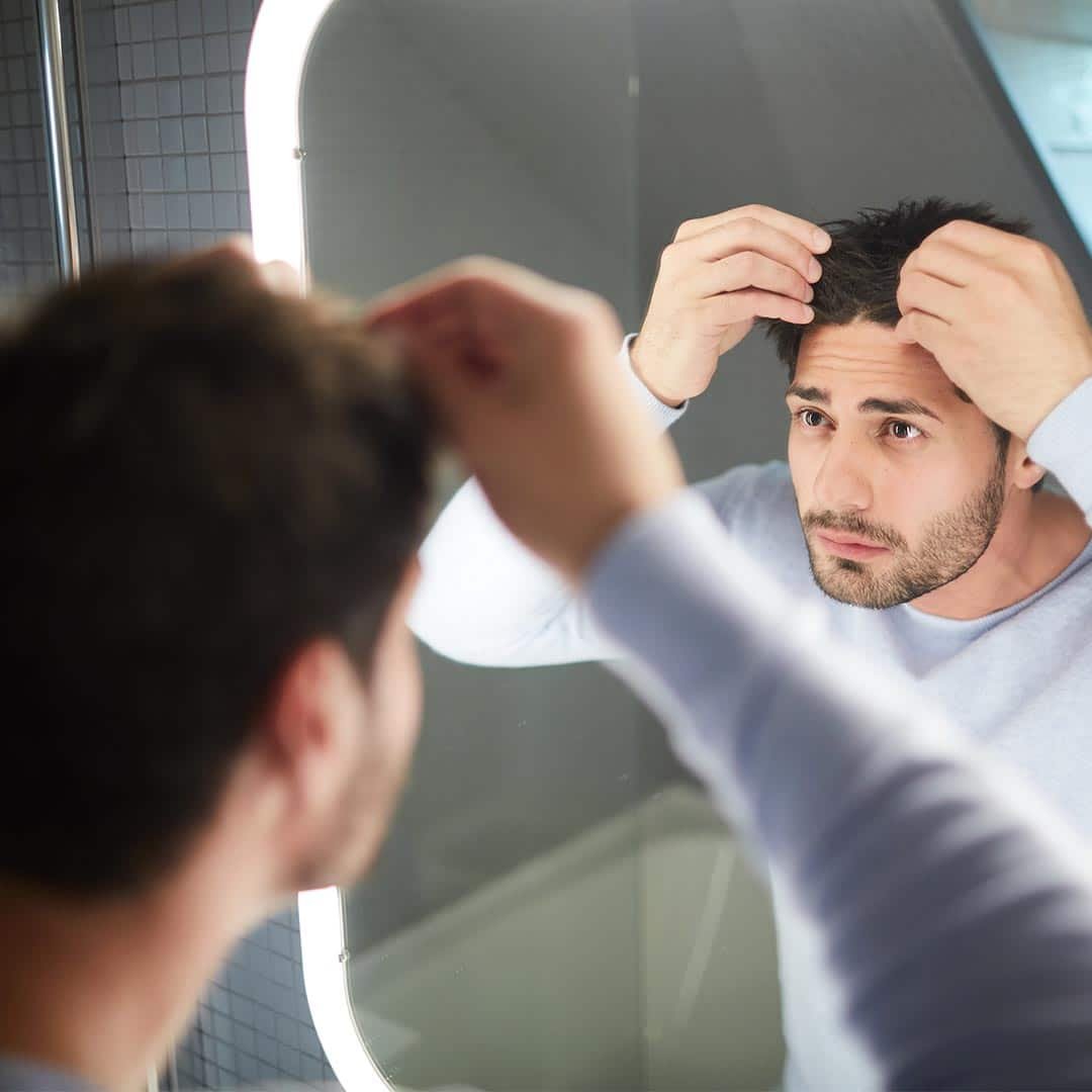 Como saber se tenho alopecia androgenética