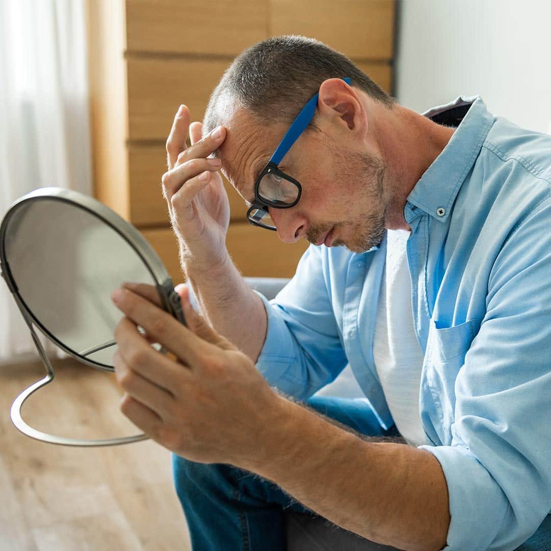 4 Passos para Identificar a Alopecia Androgenética em Homens