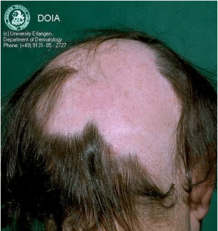 alopecia areata